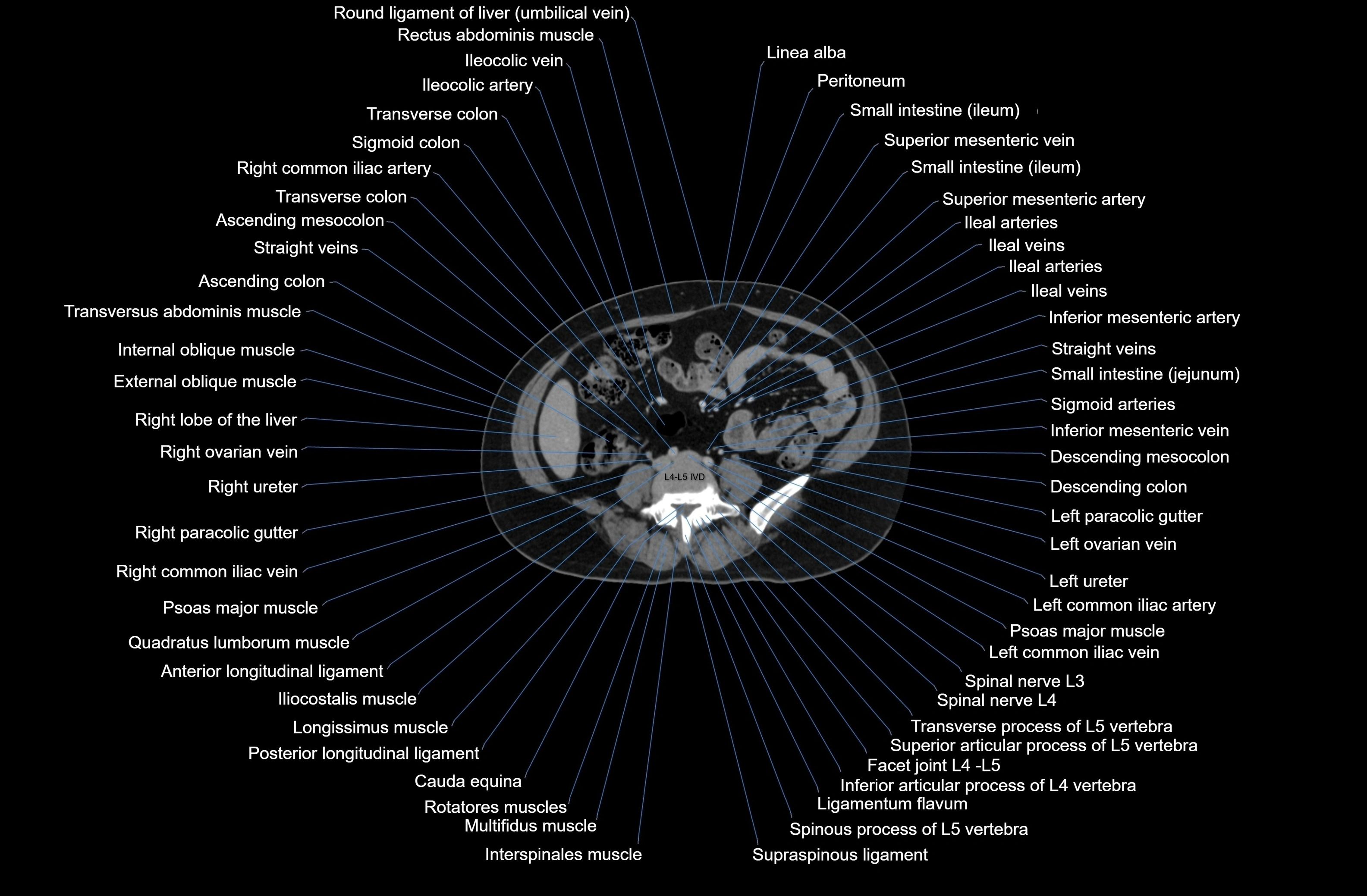 CT Abdomen axial cross sectional anatomy labelled radiology image-00056.webp
